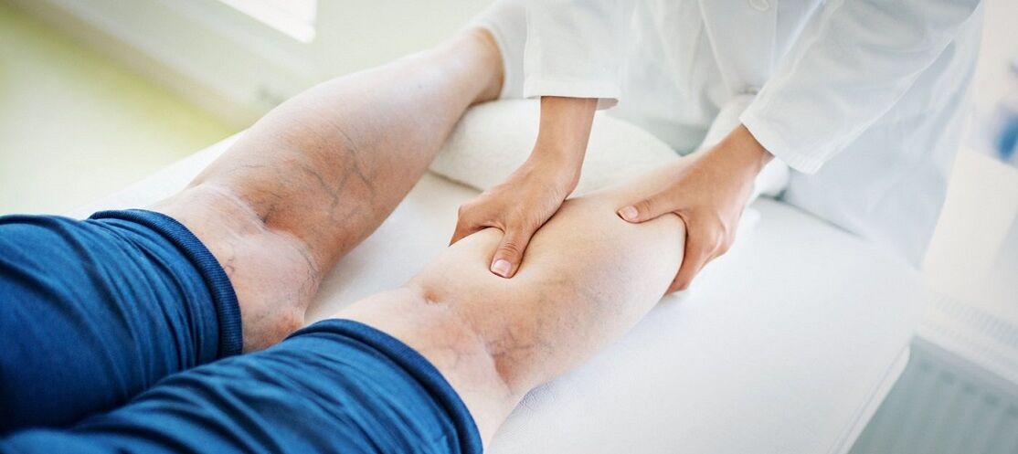 varices sur les jambes et son traitement
