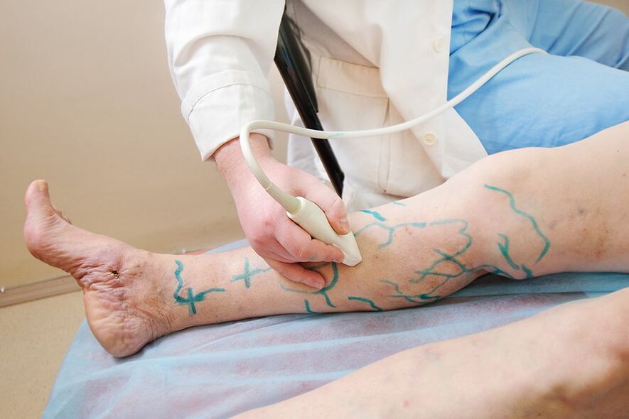 Préparation à la miniflébectomie - marquage sur les perforateurs de la jambe inférieure, réalisation d'une échographie